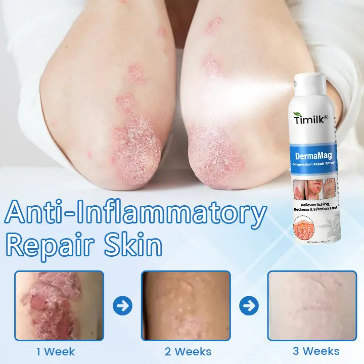 ✅ Official Store: Timilk® DermaMag Magnesium Repair Spray 🔥 FDA Certified (Clinically Proven Relief for Psoriasis, Eczema, and Chronic Skin Irritation 🌿)