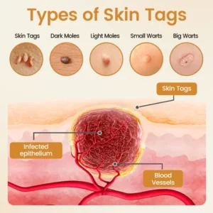 Timilk® BeeVenom Wart Renewal Spray