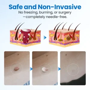 Timilk® TagGone Wart Removal Cream 🇺🇸