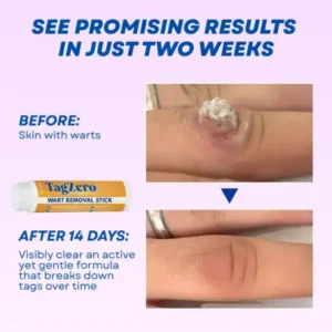 Timilk® TagZero Wart Removal Stick