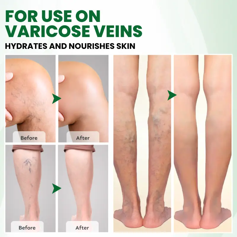 Timilk® VariPoint™ Phyto-Vascular Microneedle Patch