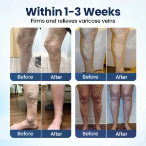 Timilk® Deep Vein Repair Microneedle Patch