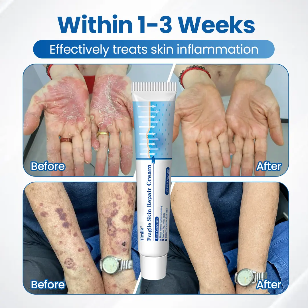 Timilk® Fragile Skin Repair Cream🛡️🌿 Multi-Repair for Bruises, Dryness & Spots