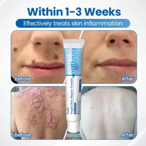 Timilk® Fragile Skin Repair Cream🛡️🌿 Multi-Repair for Bruises, Dryness & Spots