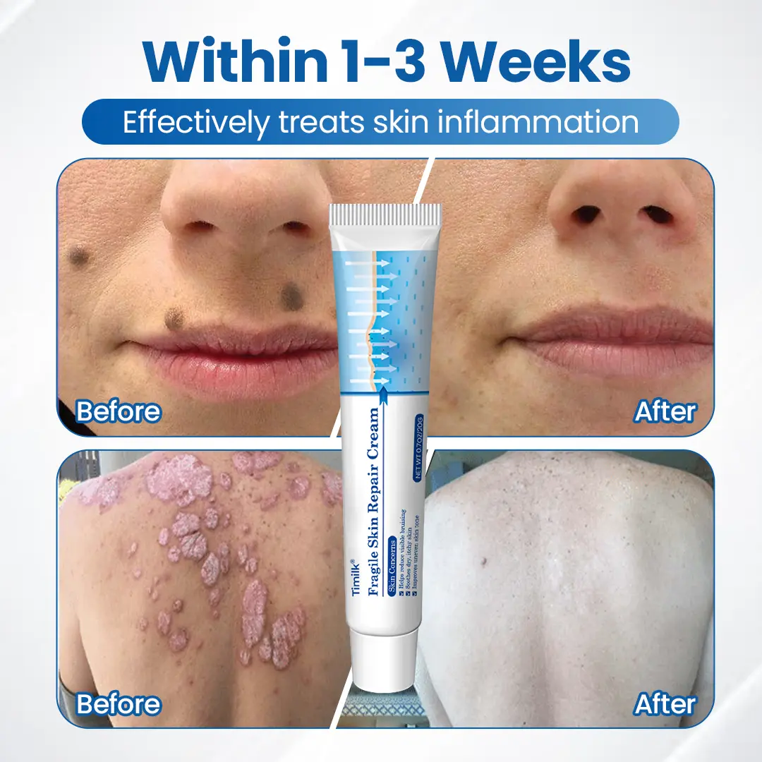Timilk® Fragile Skin Repair Cream🛡️🌿 Multi-Repair for Bruises, Dryness & Spots